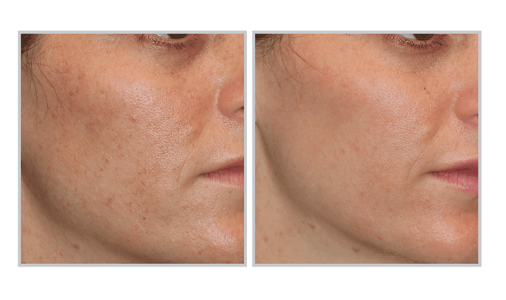 Moxi Skin Resurfacing