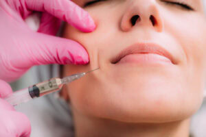 woman receiving dermal filler injection in nasolabial folds at medical spa
