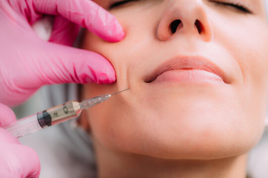 woman receiving dermal filler injection in nasolabial folds at medical spa