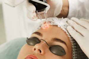 Woman in protective goggles receiving a laser skin resurfacing treatment on her forehead